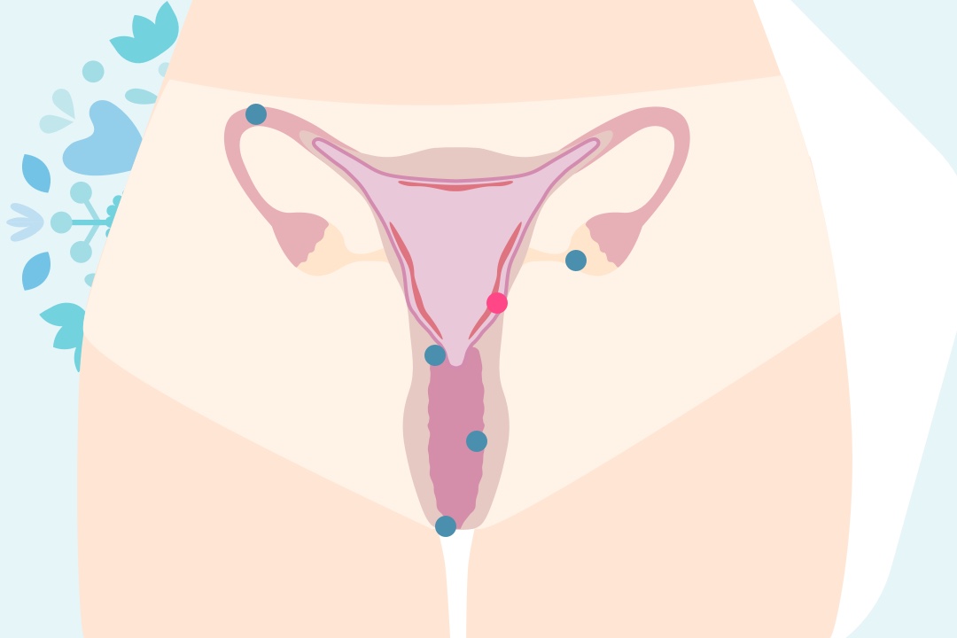 Grafika děloha (uterus)